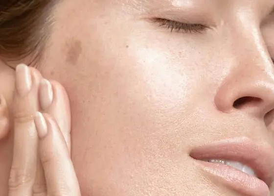 Pigmentflekker (melasma)