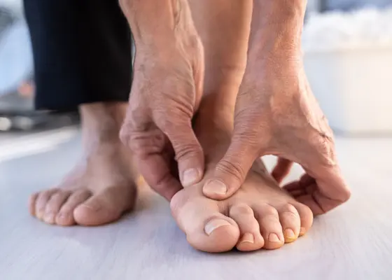 Hallux valgus Hallux valgus