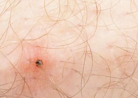 Borreliose | Symptomer og behandling
