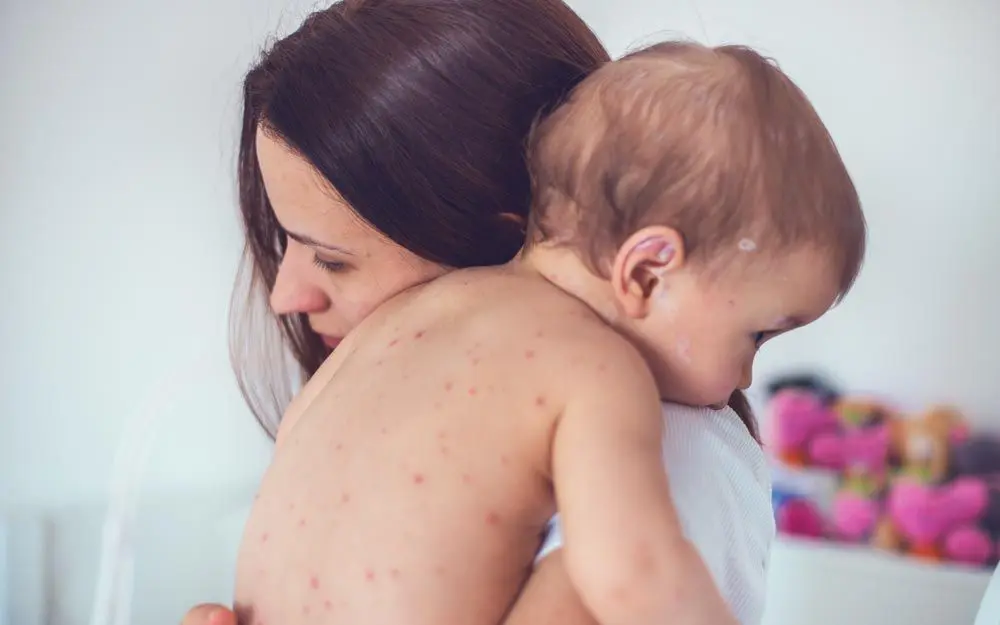 Bilde av en dame som holder et spedbarn over skulderen. Røde prikker på ryggen til barnet som ligner på vannkopper.