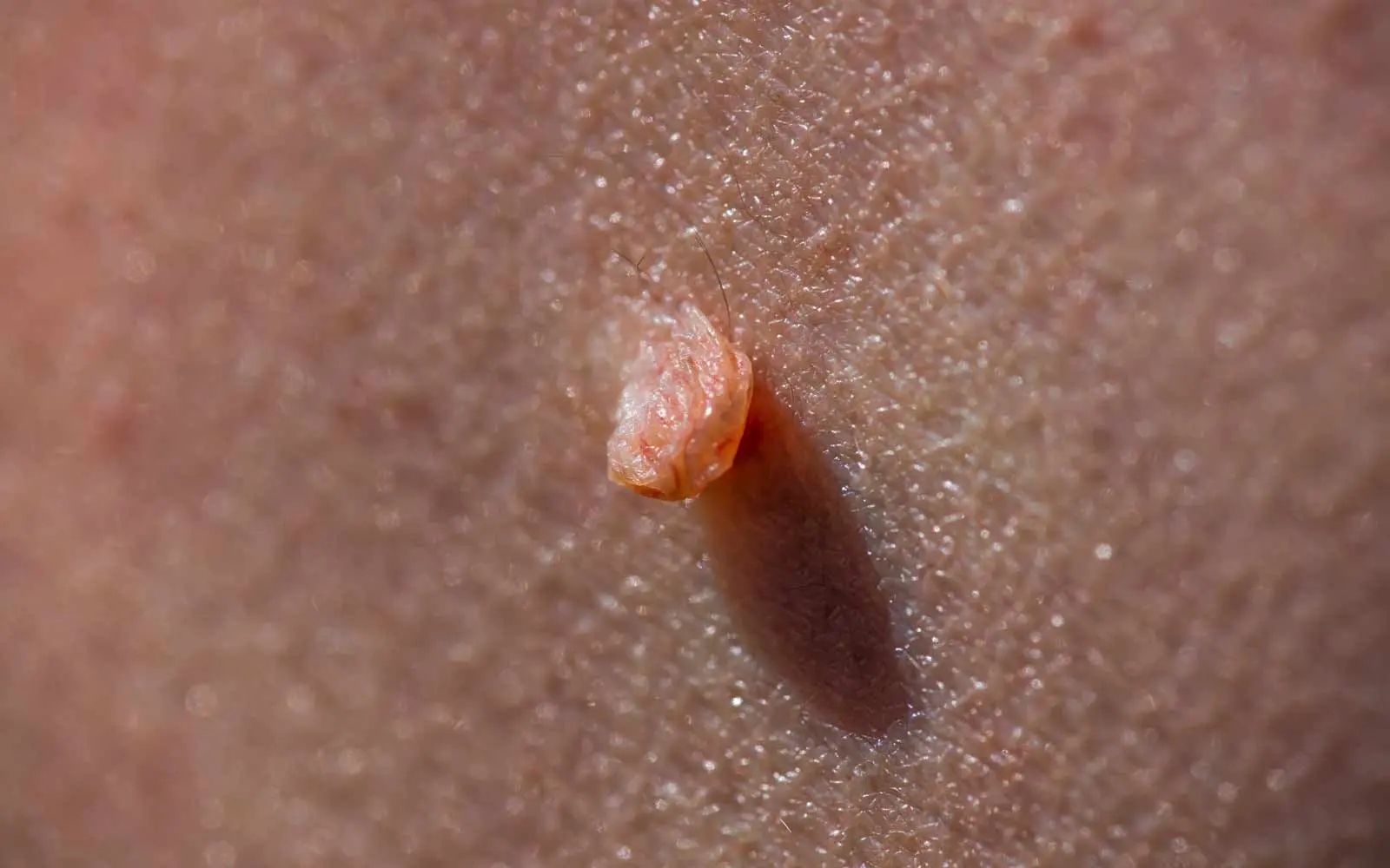 Enkel skin tag. Hudtaggen har lik farge som omkringliggende hud, og man kan skimte tynne blodårer inne i utveksten.