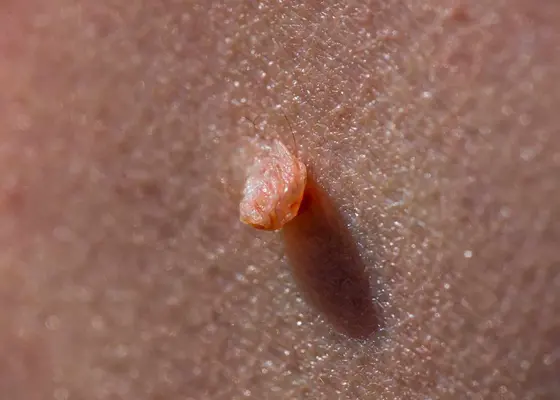 Skin tag (hudtagger) Skin tag (hudtagger)