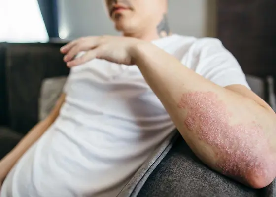 Psoriasis