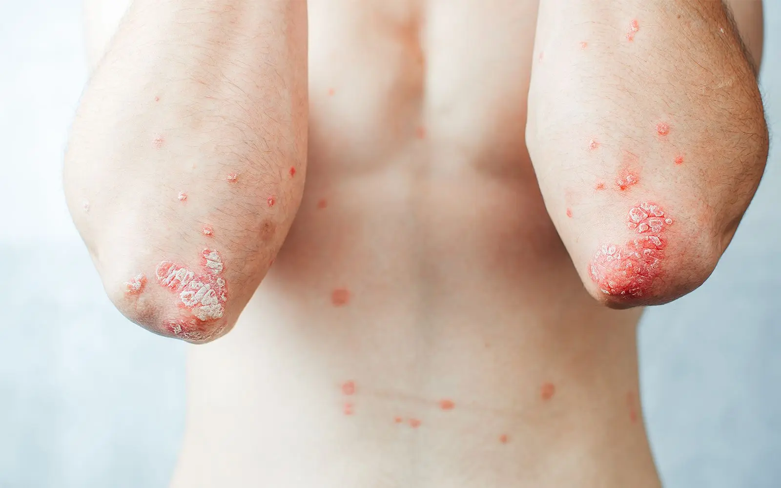 Psoriasis på albuer