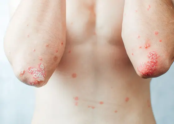 Er huden eller hodebunnen din plaget av psoriasis? Er huden eller hodebunnen din plaget av psoriasis?