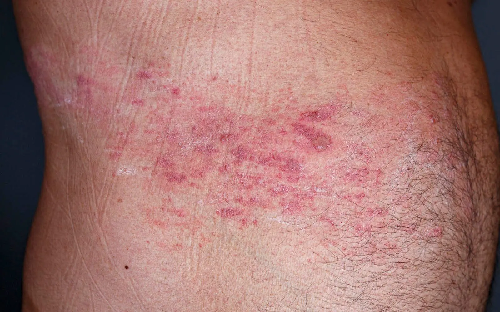 Rødt utslett med væskende blemmer sprer seg fra rygg til mage langsmed ribbeina