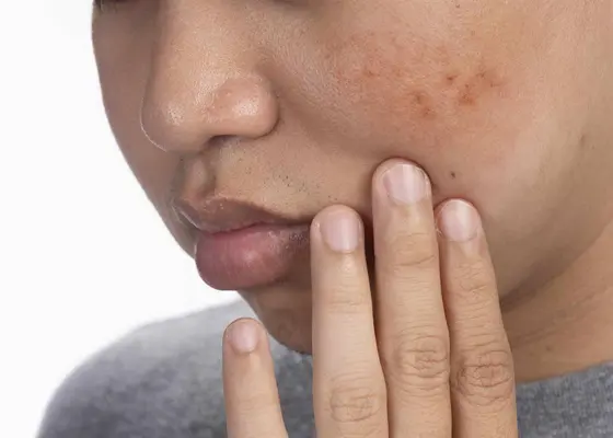 Pigmentflekker (melasma) Pigmentflekker (melasma)
