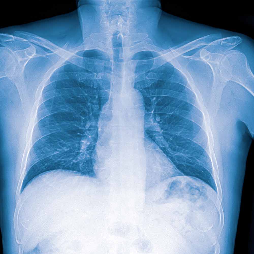 Røntgenbilde av lunger. Lungebetennelse ses som hvite områder på lungene.