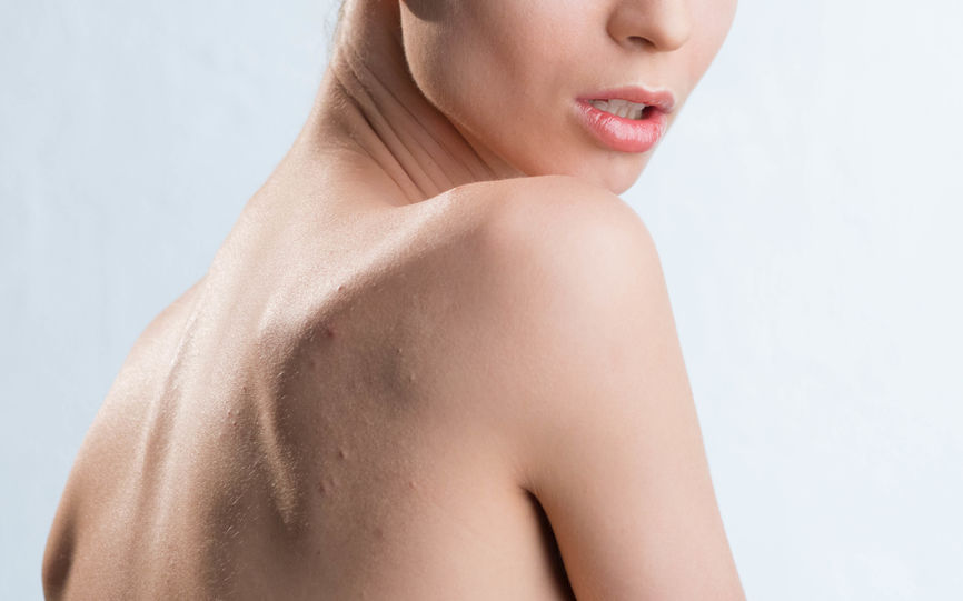 Kviser Pa Ryggen Vitusapotek