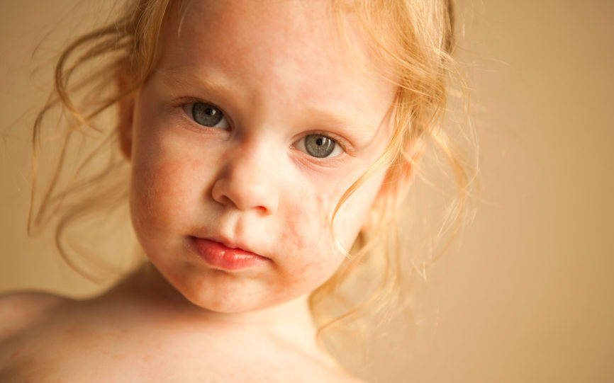 Nærbilde av ansiktet til en liten jente. Jenta har rødflekket utslett på haken, i pannen og på kinnene.
