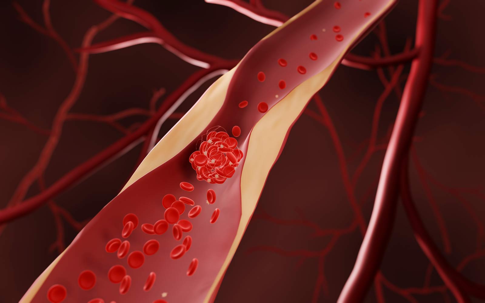 Illustrasjon av en blodpropp som dannes i en blodåre som er innsnevret grunnet åreforkalkning.