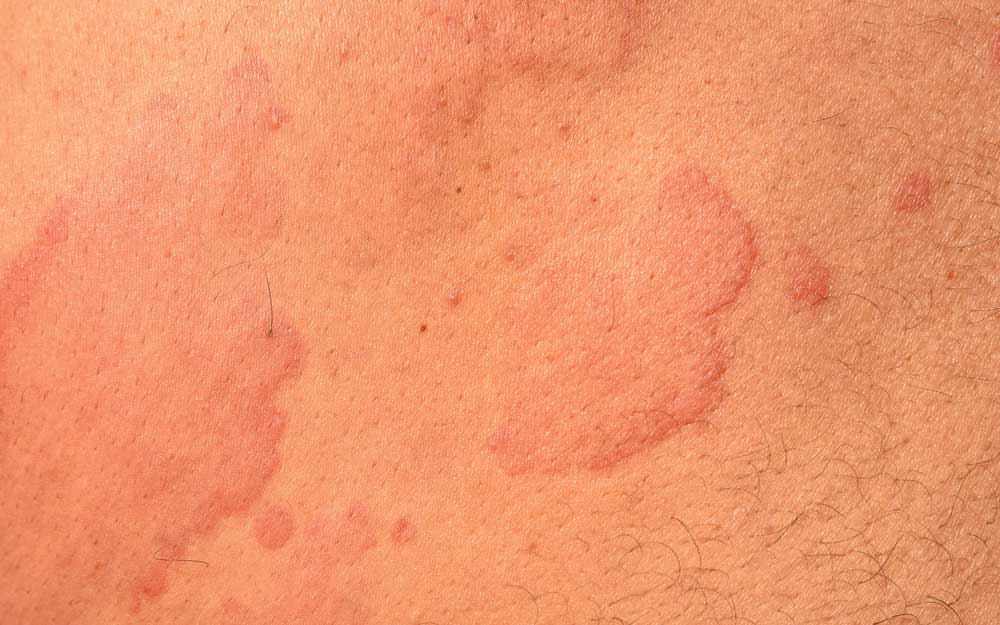 Nærbilde av utslett ved elveblest. Ved kuldeallergi oppstår et elveblest-lignende utslett med rosa, hvite eller røde vabler og hevelse i huden.