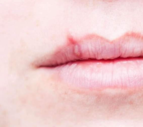 Nærbilde av en munn. På overleppen er et munnsår forårsaket av herpes virus.