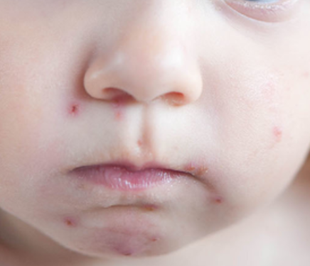 Nærbilde av et barns ansikt. Barnet har vannkopper.