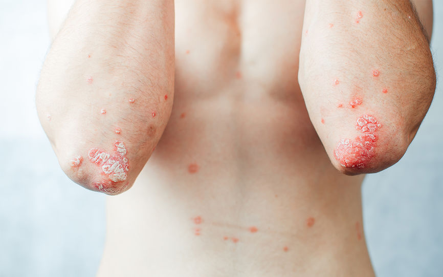 Psoriasis på albuer