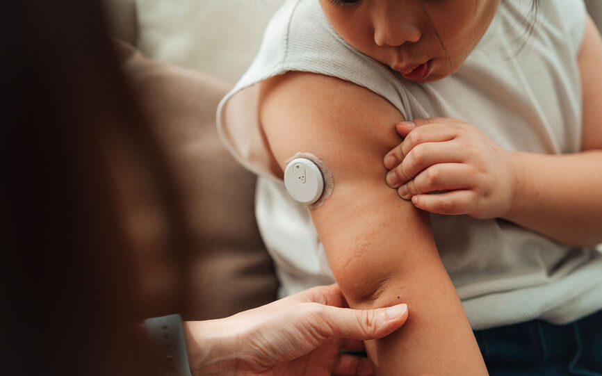 Et barn med CGM sensor på armen