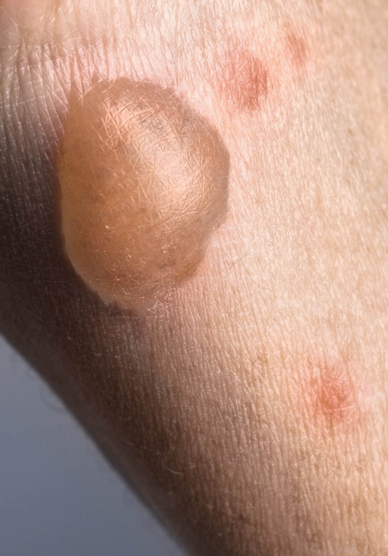 Bilde av 2.gradsforbrenning. Huden har en stor væskefylt blemme.