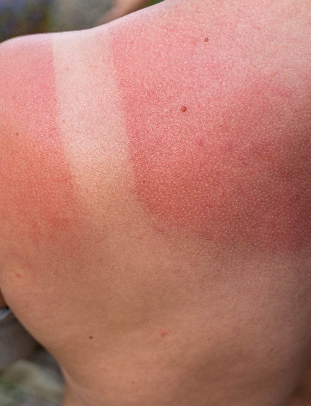 Bildet viser en rød, solbrent skulder med tydelig skille der huden har vært beskyttet av klær.