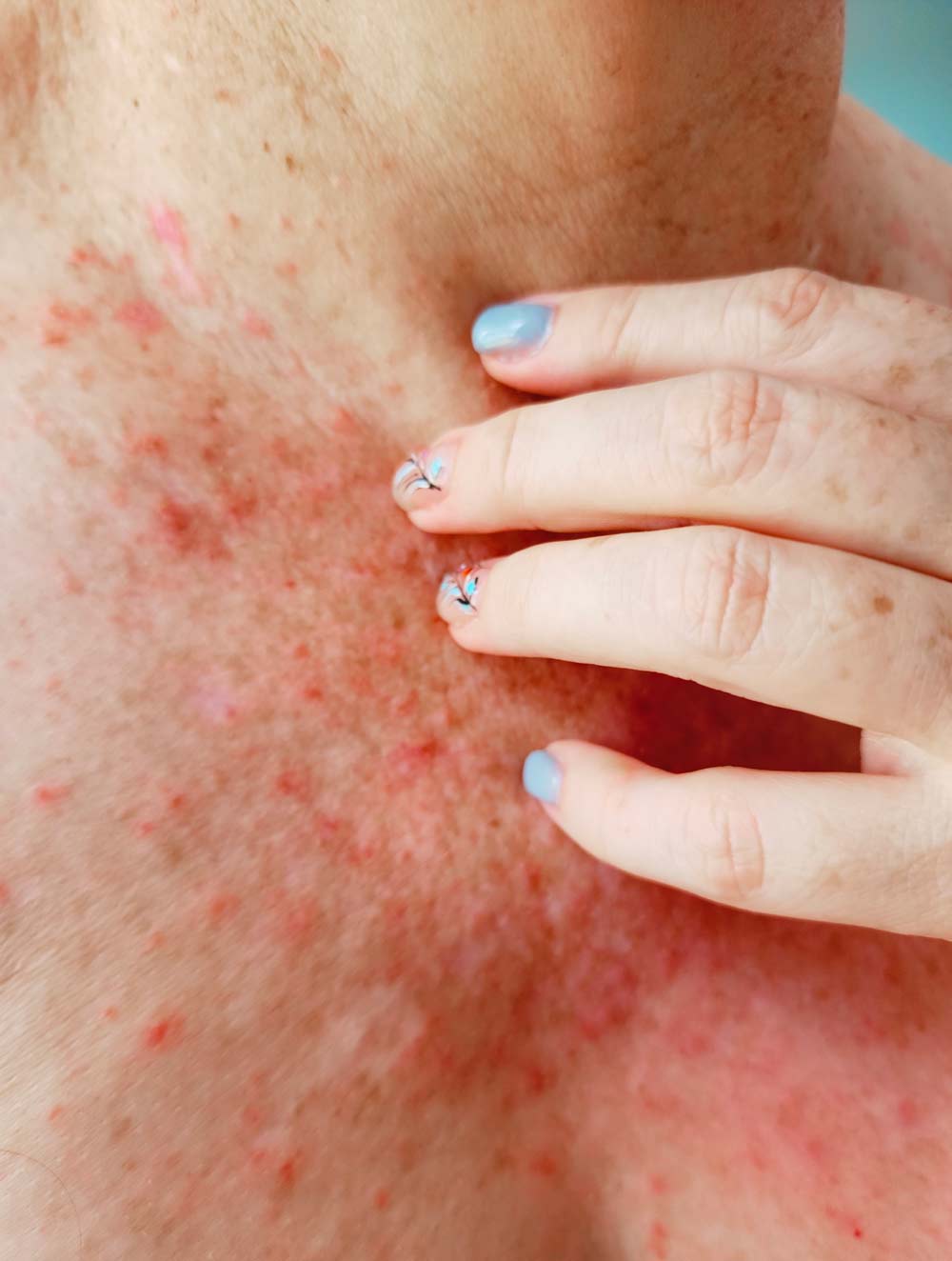 Bildet viser eksempel på soleksem på hals og bryst. Utslettet er rødt og nuppete.