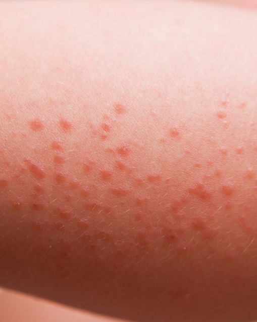 Bildet viser varmeutslett med røde nupper.
